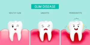 Why Do My Gums Bleed When I Brush My Teeth — Causes & Treatments 2026