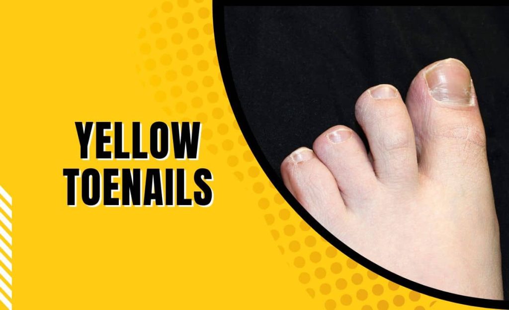 Why Are My Toenails Yellow? Easy Fixes That Work 2026