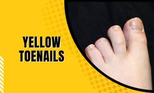 Why Are My Toenails Yellow? Easy Fixes That Work 2026