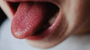 Why Does My Tongue Hurt? Causes & Relief 2026