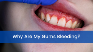 Why Are My Gums Bleeding? Signs You Should Not Ignore in 2026