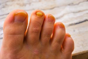 Why Is My Toenail Yellow? Causes & Prevention Tips 2026