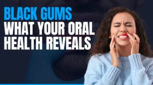 Why Are My Gums Black? Causes & Treatment 2026