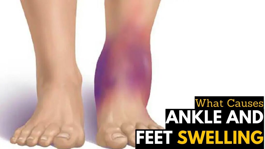 Why Do My Ankles Swell? Symptoms & Treatment 2026