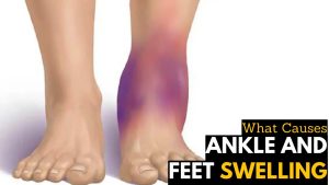 Why Do My Ankles Swell? Symptoms & Treatment 2026