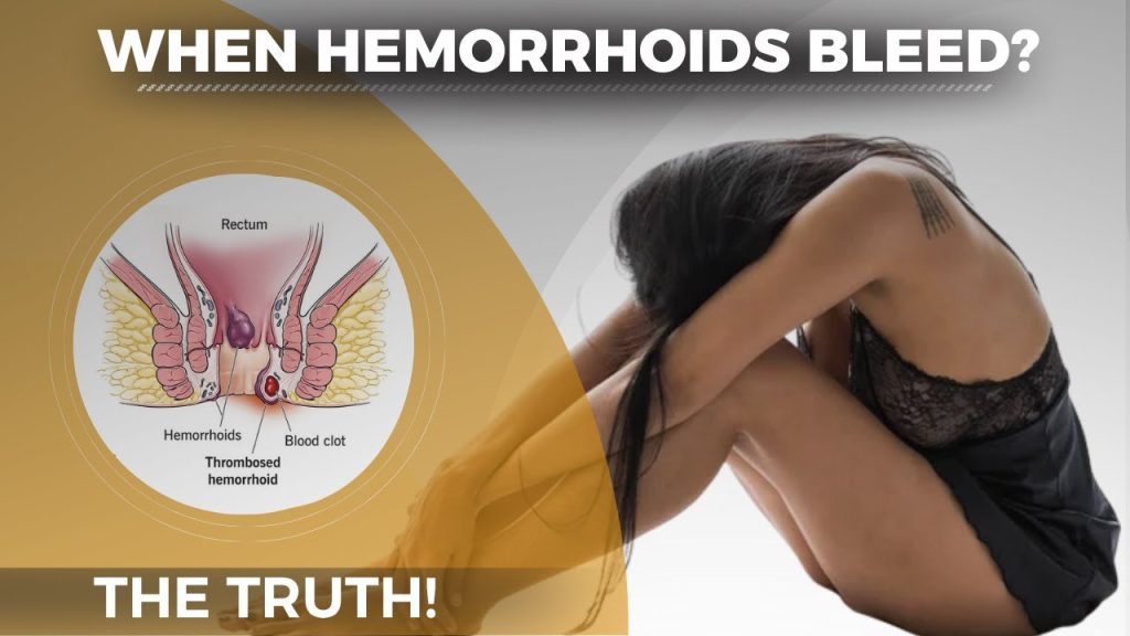 Why Do Hemorrhoids Bleed? Expert Advice & Solutions 2026