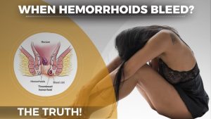 Why Do Hemorrhoids Bleed? Expert Advice & Solutions 2026