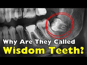 Why Are They Called Wisdom Teeth? Origin & Facts 2026