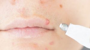 Why Do I Have a Bump on My Lip? Easy Treatments 2026