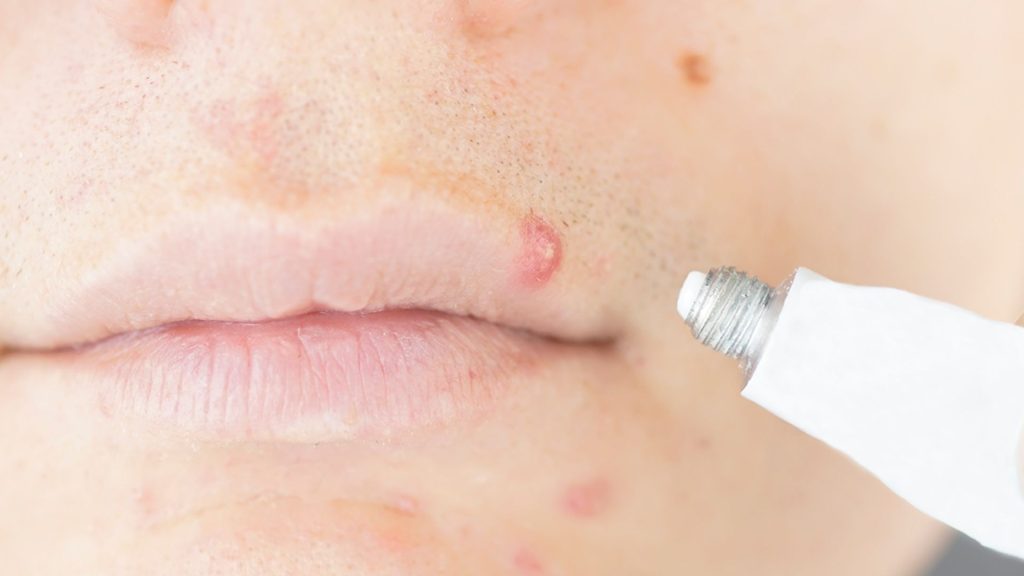 Why Do I Have a Bump on My Lip? Easy Treatments 2026