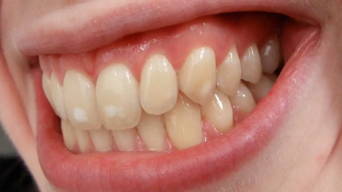Why Do I Have White Spots on My Teeth? Common Reasons 2026