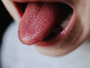 Why Do I Have Bumps on My Tongue? Should You Worry in 2026