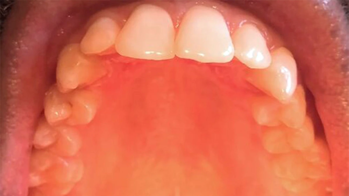 Why Does the Top of My Mouth Hurt? Relief Tips 2026
