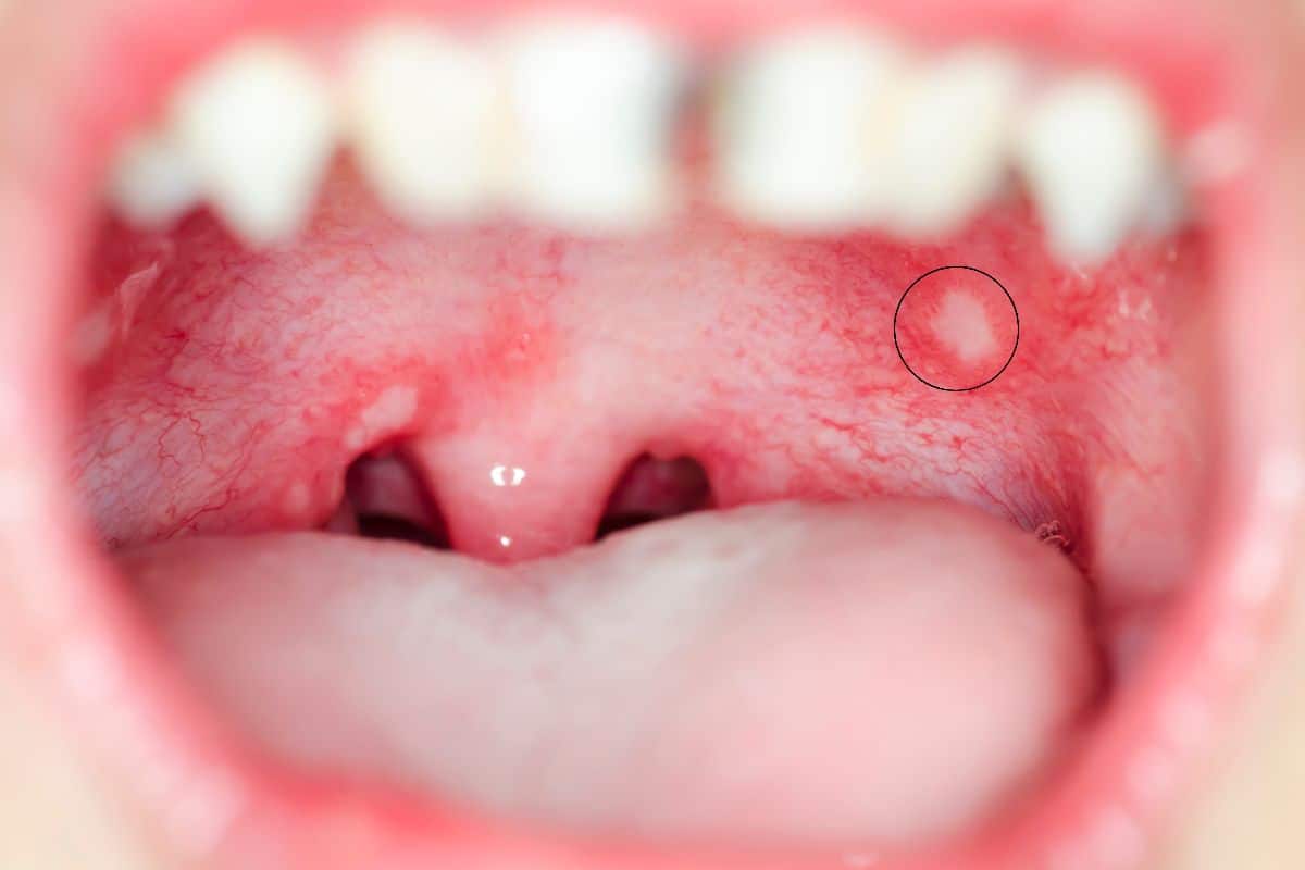 Why Does the Roof of My Mouth Hurt When I Eat? Fix 2026