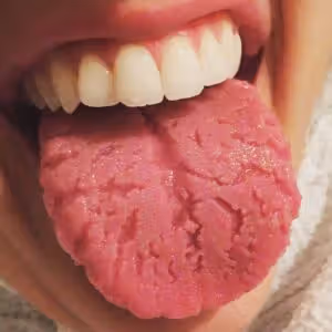 Why Does My Tongue Have Cracks? Is It Normal? 2026