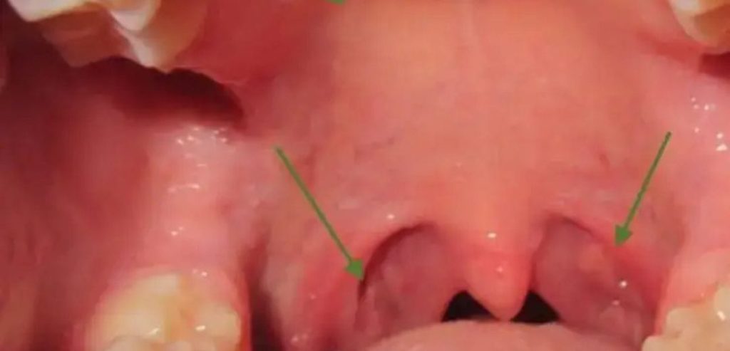 Why Is the Roof of My Mouth Itchy? Allergy Warning? 2026