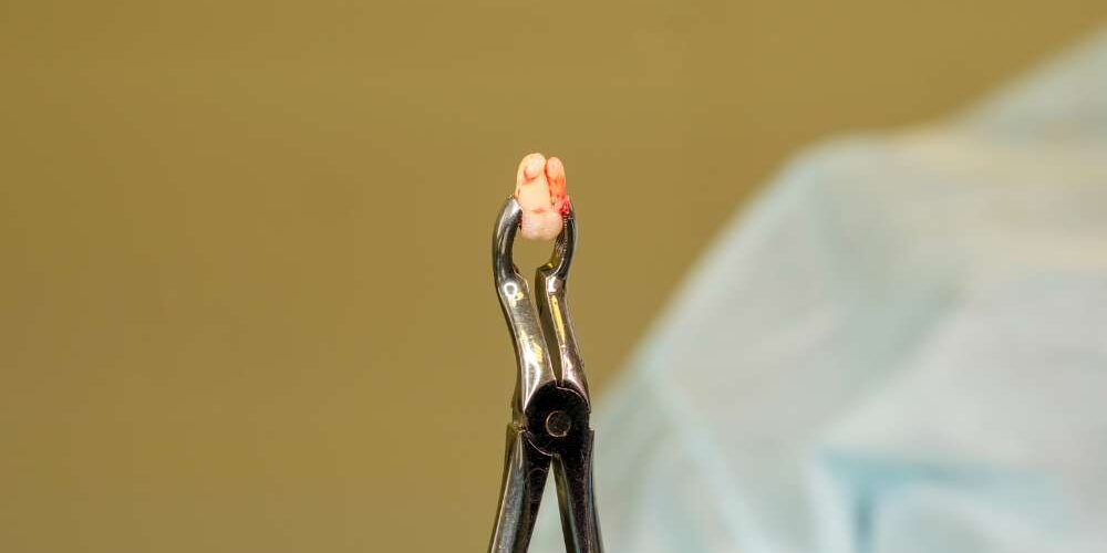 Why Experts Now Say Not to Remove Your Wisdom Teeth? 2026