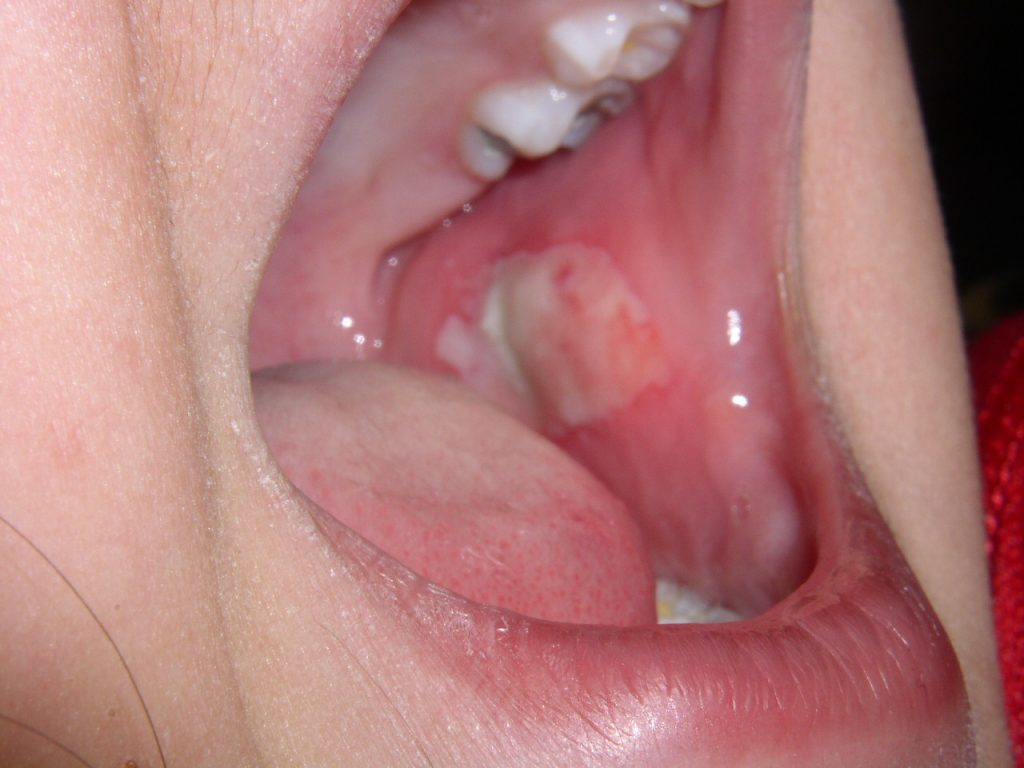 Why Do I Keep Biting My Cheek? Dental Causes 2026