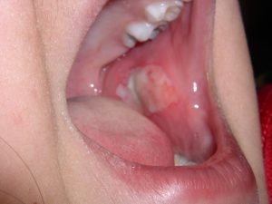Why Do I Keep Biting My Cheek? Dental Causes 2026
