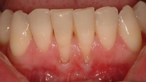 Why Are My Gums Receding? Causes & Treatment 2026