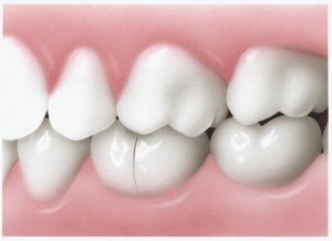Why Does My Teeth Hurt When I Bite Down on One Side? 2026