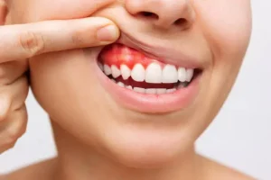 Why Is My Gum Swollen Around One Tooth? Signs to Know 2026