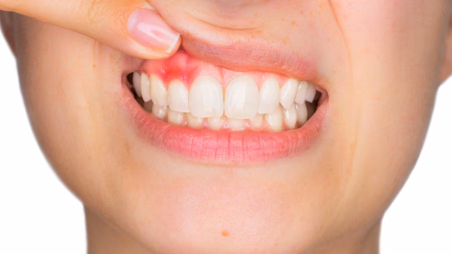 Why Does My Gum Hurt? Home Remedies That Actually Help 2026