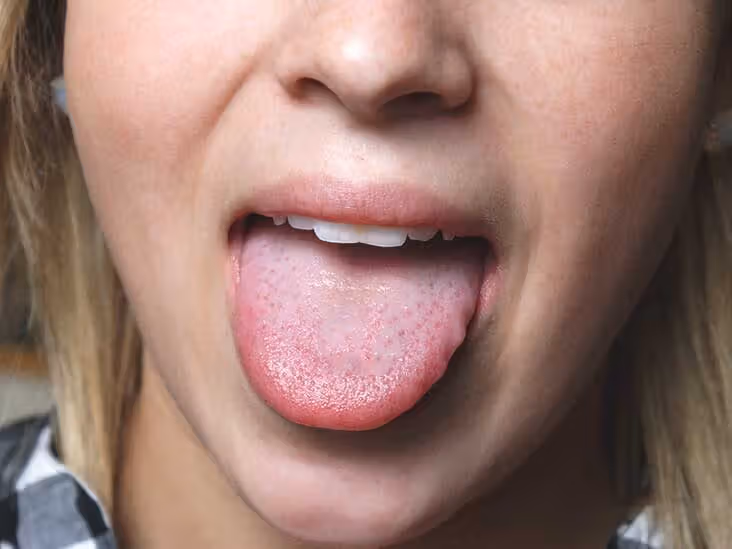 Why Is My Tongue Swollen and Sore on the Sides? Relief Tips 2026