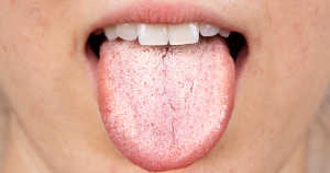 Why Is My Tongue White? Signs to Watch For 2026