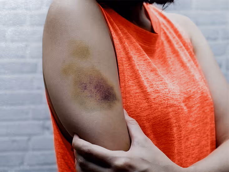 Why Am I Bruising So Much? Causes & When to Worry 2026