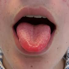 Why Does the Tip of My Tongue Hurt? What It Means 2026