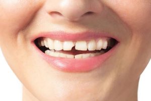 Why Are My Teeth Chipping? Signs to Watch 2026