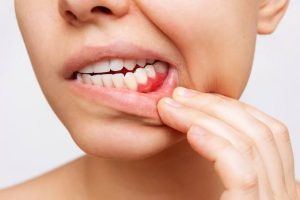 Why Does My Gums Hurt? What It Means & What to Do 2026