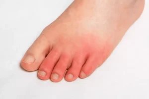 Why Are the Bottoms of My Feet Red? Quick Guide 2026
