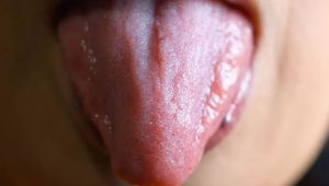 Why Are My Taste Buds Swollen? Treatment Tips 2026