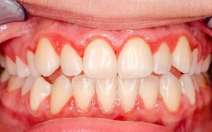 Why Do Gums Bleed? Signs You Shouldn't Ignore 2026