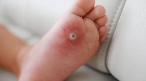 Why Do Kids Get Warts? Easy Treatment Tips 2026