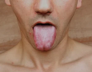 Why My Tongue White? Is It Something Serious? (2026 Guide)