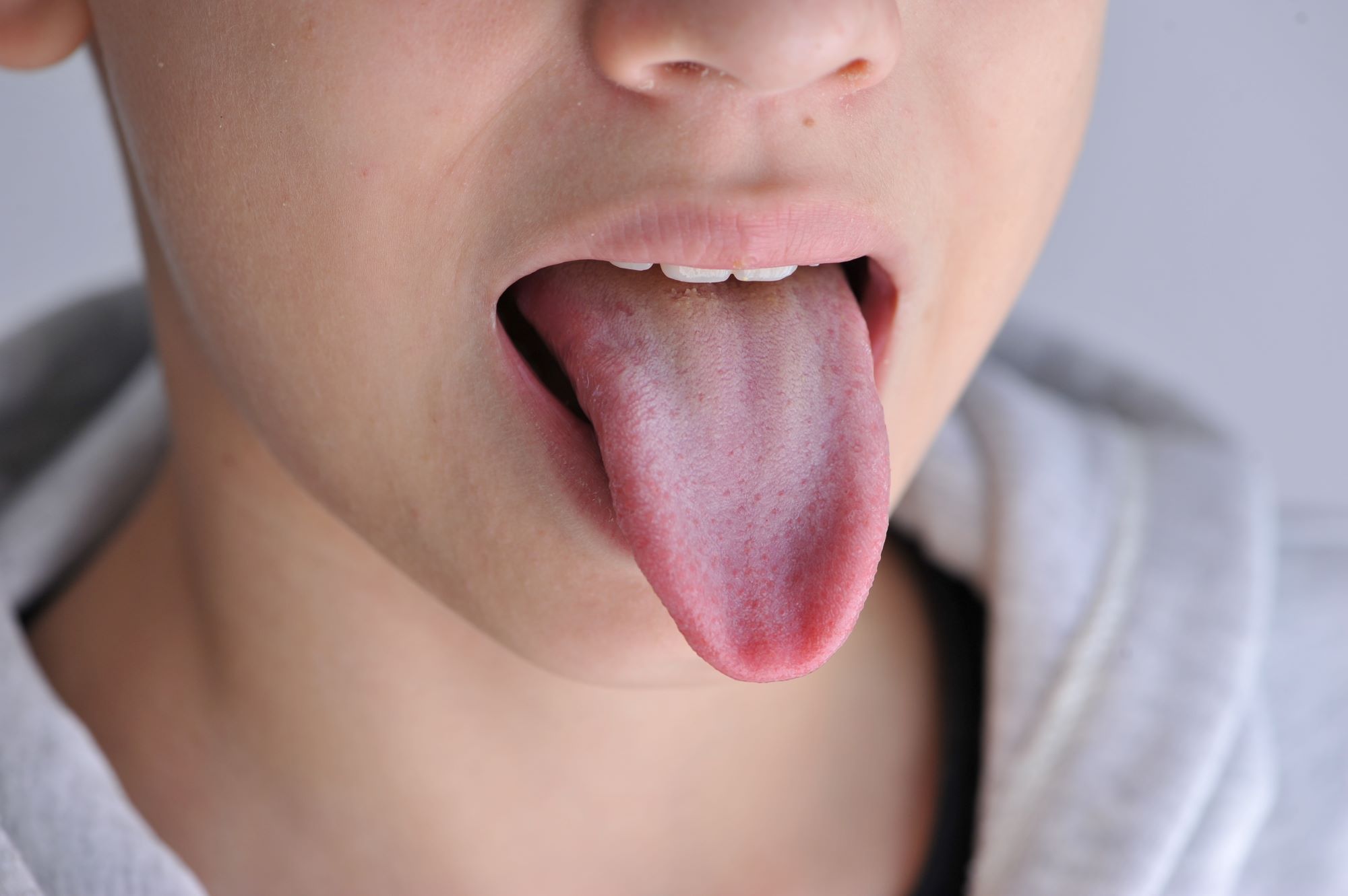 Why Do I Have a White Bump on My Tongue? Causes 2026