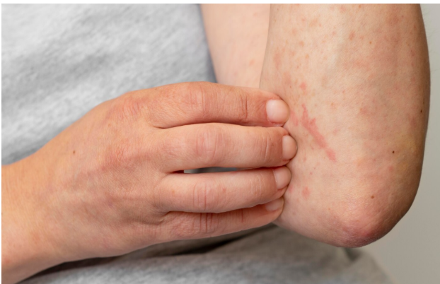 How To Relieve Viral Hives Symptoms During And After An Infection