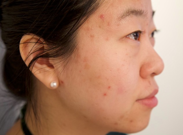 Acne Face Wash Mistakes That Worsen Breakouts