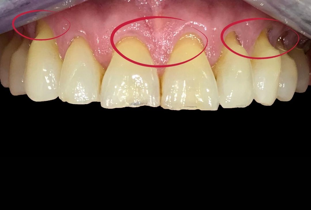 Why Does My Front Tooth Hurt? Causes, Relief, and When to See a Dentist 2026