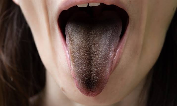 Why Does Pepto Bismol Cause Black Tongue? Full Explanation 2026