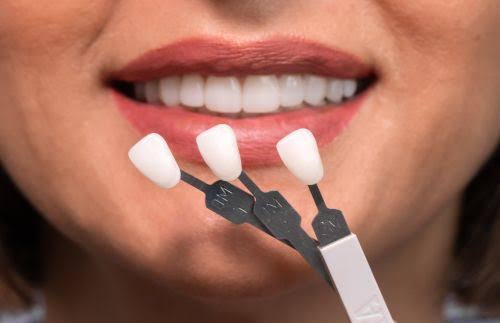Why Veneers Are Bad: The Real Risks, Myths, and What to Know First 2026