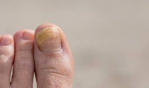 Why Are My Toenails Yellow? Causes, Remedies, and When to See a Doctor 2026