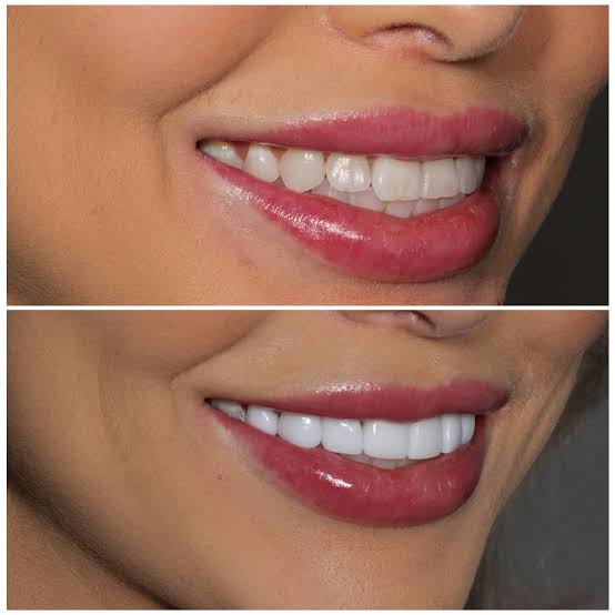 Why Veneers Are Bad: The Real Risks, Myths, and What to Know First 2026