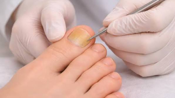 Why Are My Toenails Yellow? Causes, Remedies, and When to See a Doctor 2026