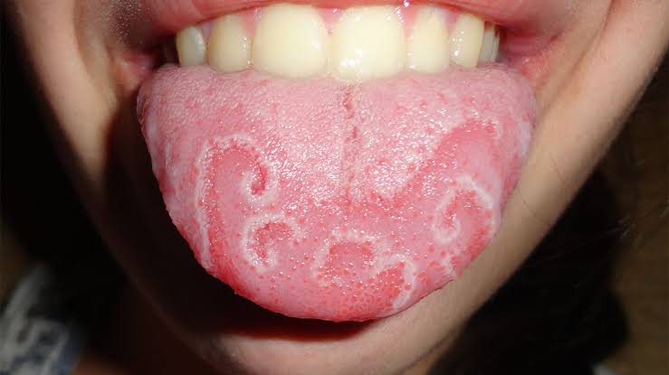 Why Do I Have a White Bump on My Tongue? Causes 2026