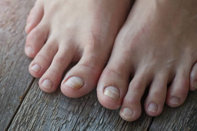 Why Are My Toenails Yellow? Causes, Remedies, and When to See a Doctor 2026