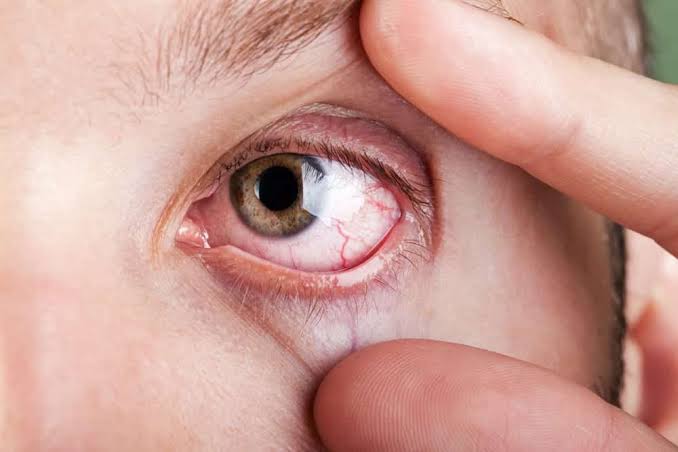Why Does My Eye Hurt When I Rub It? Causes & Relief 2026